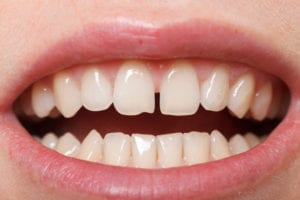 Diastema between the upper incisors in need of frenectomy.