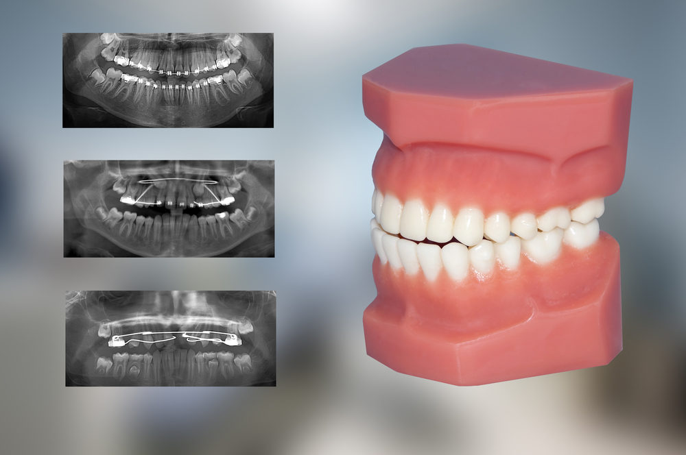 dental model and x-ray of three fixed appliances used for ortho