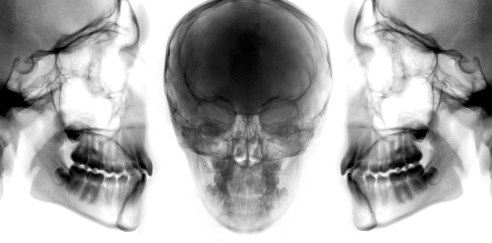 x rays of mandible maxilla and skull