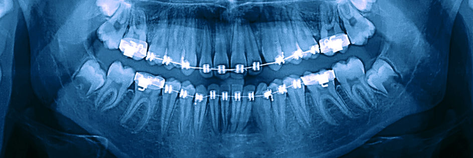 x ray of teeth with orthodontic braces