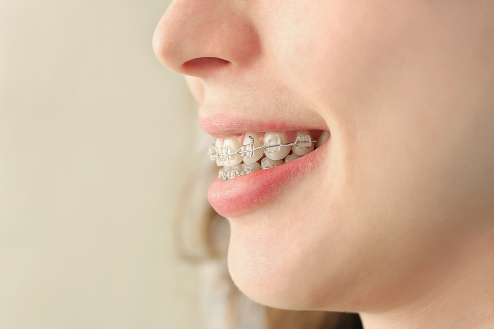 close up of girl smiling with teeth braces