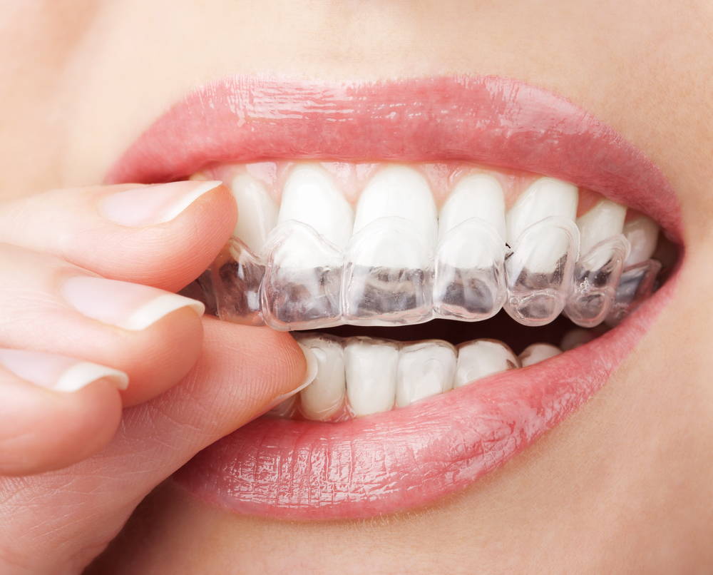 female patient placing Invisalign tray over teeth