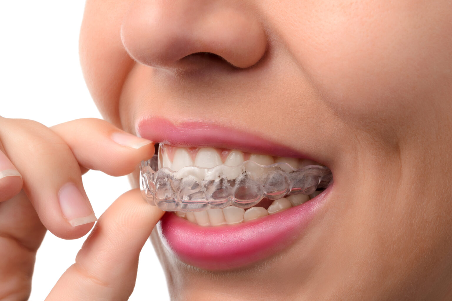 woman inserting Invisalign aligners