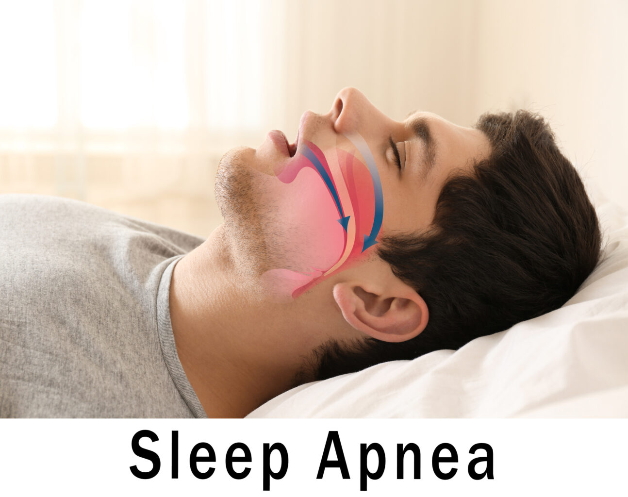 man with sleep apnea diagram drawn on face