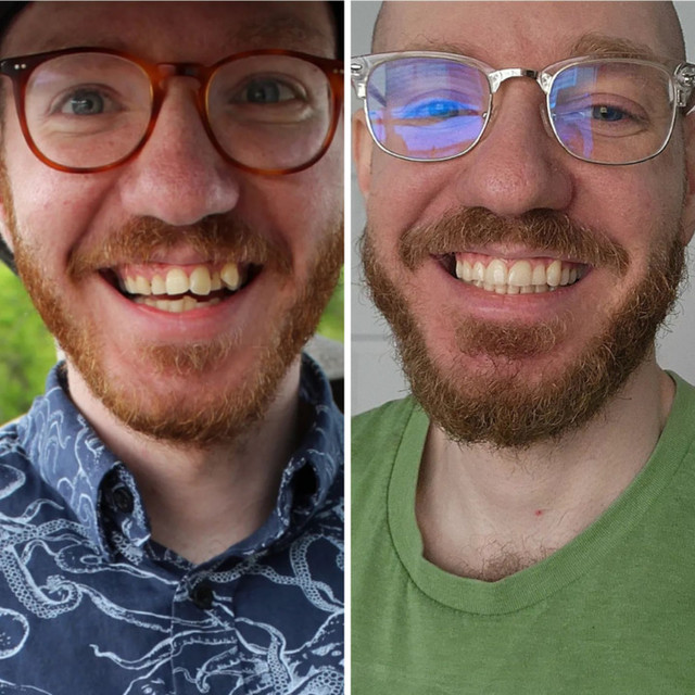 invisalign cost and before and after images