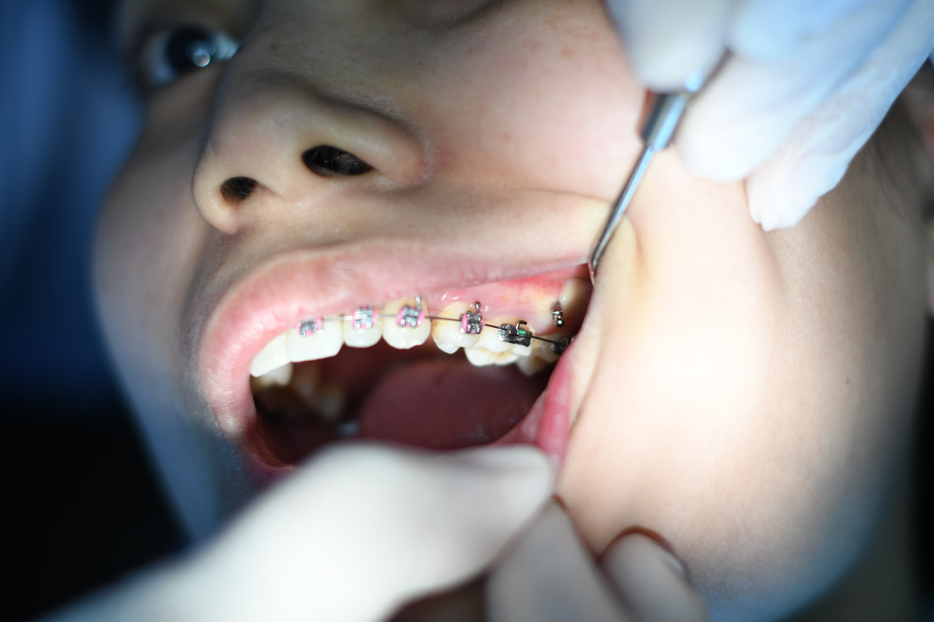 close up of woman getting teeth braces