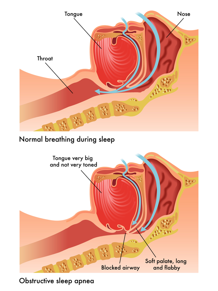 diagram of apnea sleep