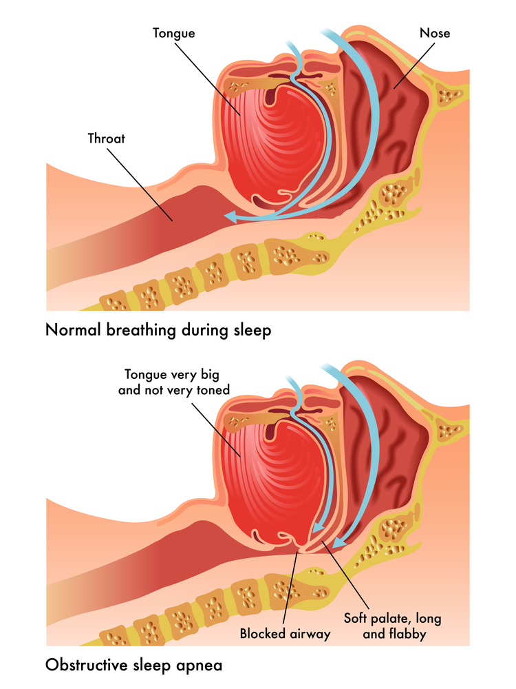 What Causes Sleep Apnea? - StoryMD