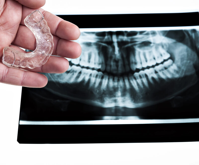 x-ray of person with a bad bite and doctor holding an oral appliance