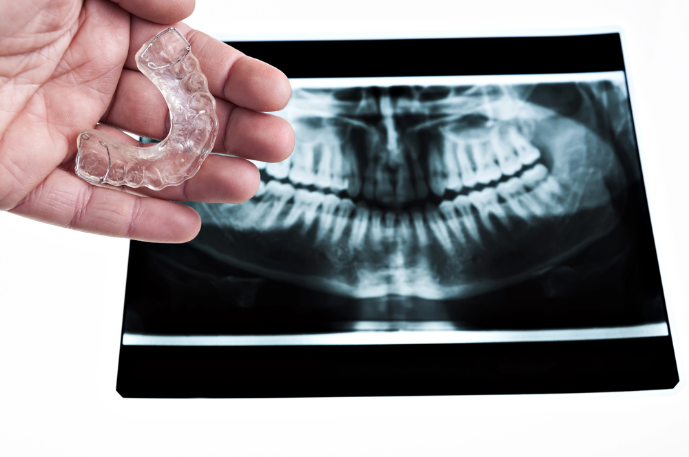 x-ray of person with a bad bite and doctor holding an oral appliance