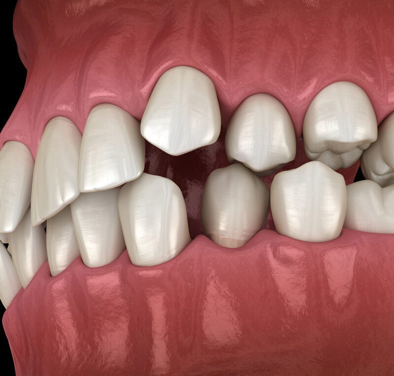 Abnormal teeth position, orthodontic concept. Medically accurate tooth 3D illustration