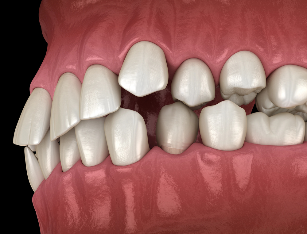 Abnormal teeth position, orthodontic concept. Medically accurate tooth 3D illustration