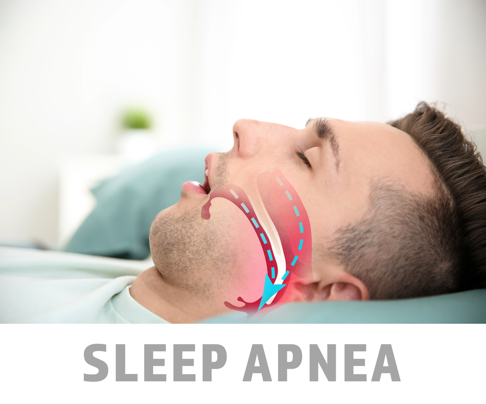 man with sleep apnea sleeing, diagram shows airways