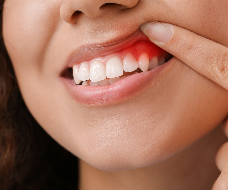 Woman with gum inflammation, closeup