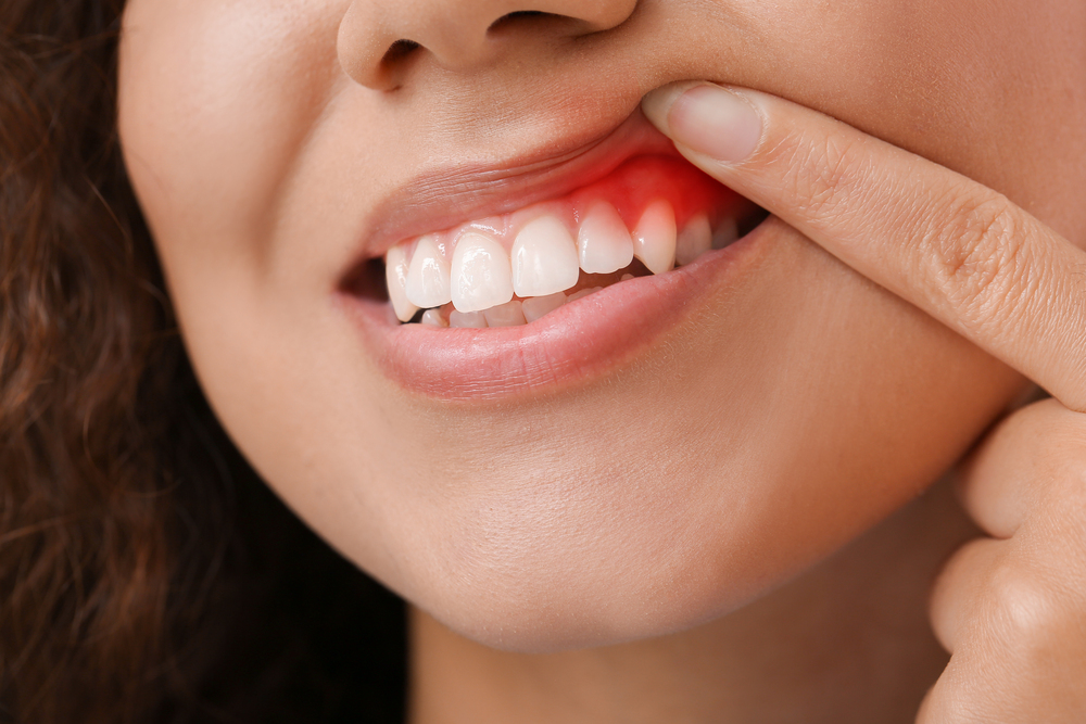 Woman with gum inflammation, closeup