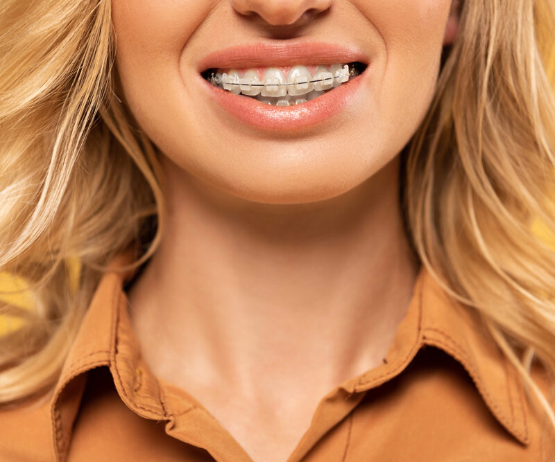 close up of woman with braces