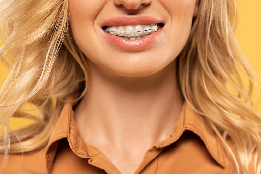 close up of woman with braces